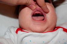 Bebeklerde Diş Çıkarma