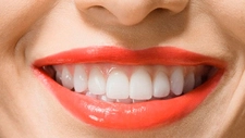 Diş Estetiğinin Faydaları Nelerdir?