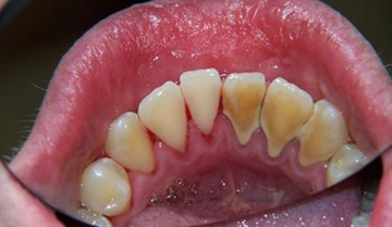 Diş Taşı Nedir? ve Diş Taşı Nasıl Tedavi Edilir