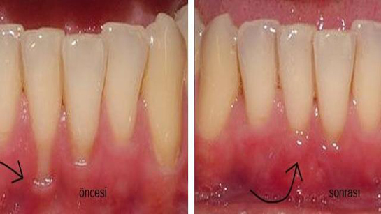 Diş Eti Hastalıkları Tedavisi