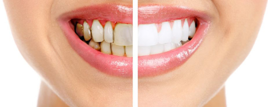 Diş Hastalıkları Belirtileri ve Tedavisi