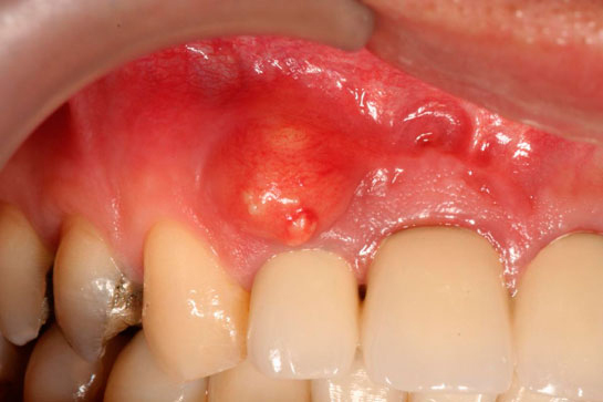 Diş Kisti Belirtileri ve Tedavisi