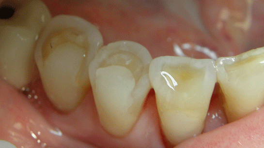 Diş Plağı Türleri ve Özellikleri