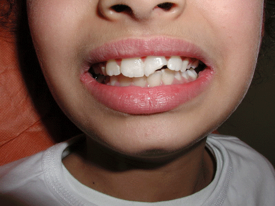 Kırık Diş Tedavisi