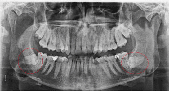 Yirmilik Diş Ameliyatı